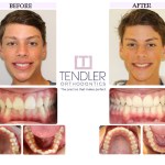 Patient Photo: Invisalign Case 9 Before & After