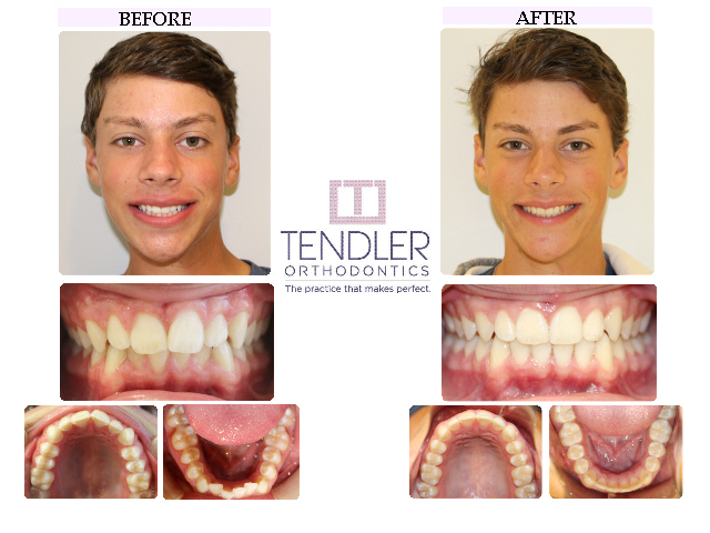 Patient Photo: Invisalign Case 9 Before & After