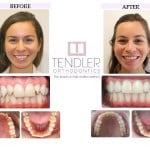 Patient Photo: Invisalign Case 1 Before & After