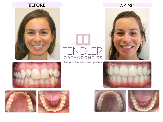 Patient Photo: Invisalign Case 1 Before & After