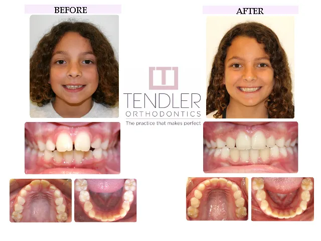 Patient Photo: Interceptive Braces (Phase 1) Case 1 Before & After