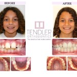 Patient Photo: Interceptive Braces (Phase 1) Case 1 Before & After