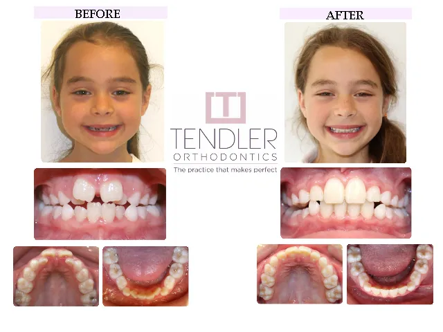 Patient Photo: Interceptive Braces (Phase 1) Case 2 Before & After
