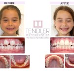 Patient Photo: Interceptive Braces (Phase 1) Case 2 Before & After