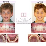 Patient Photo: Interceptive Braces (Phase 1) Case 3 Before & After