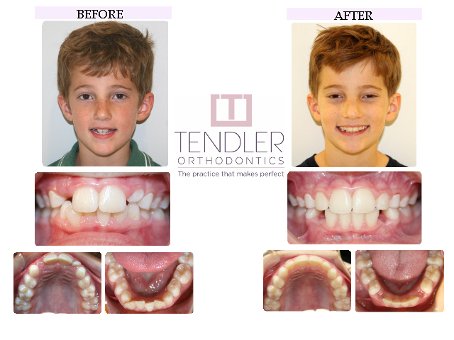 Patient Photo: Interceptive Braces (Phase 1) Case 3 Before & After