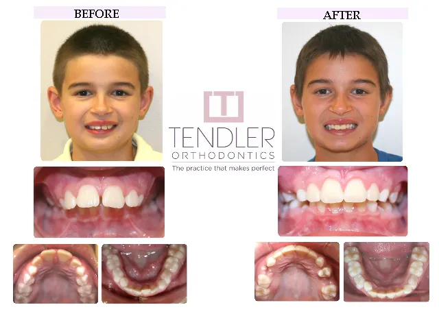 Patient Photo: Interceptive Braces (Phase 1) Case 4 Before & After