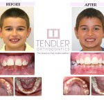 Patient Photo: Interceptive Braces (Phase 1) Case 4 Before & After