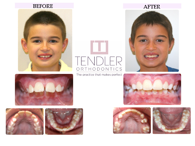 Patient Photo: Interceptive Braces (Phase 1) Case 4 Before & After