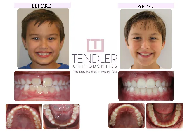 Patient Photo: Interceptive Braces (Phase 1) Case 5 Before & After