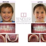 Patient Photo: Interceptive Braces (Phase 1) Case 5 Before & After
