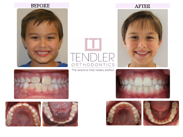 Patient Photo: Interceptive Braces (Phase 1) Case 5 Before & After