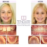 Patient Photo: Interceptive Braces (Phase 1) Case 6 Before & After