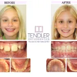Patient Photo: Interceptive Braces (Phase 1) Case 6 Before & After