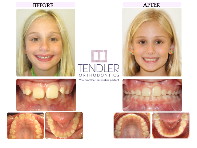 Patient Photo: Interceptive Braces (Phase 1) Case 6 Before & After