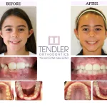 Patient Photo: Interceptive Braces (Phase 1) Case 7 Before & After