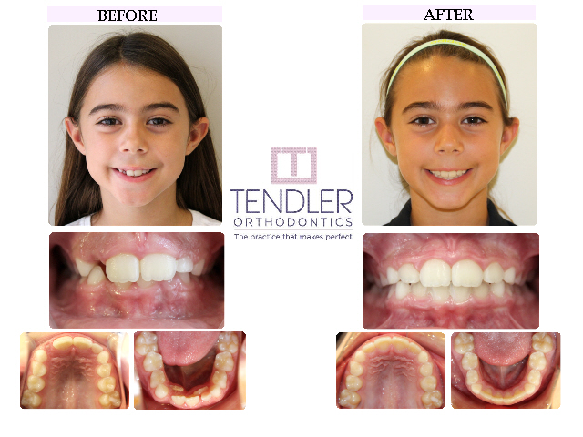 Patient Photo: Interceptive Braces (Phase 1) Case 7 Before & After