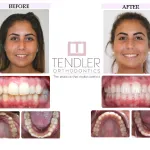 Patient Photo: Invisalign Case 2 Before & After