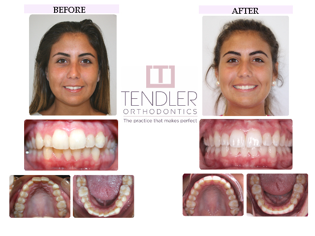 Patient Photo: Invisalign Case 2 Before & After