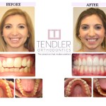 Patient Photo: Invisalign Case 8 Before & After