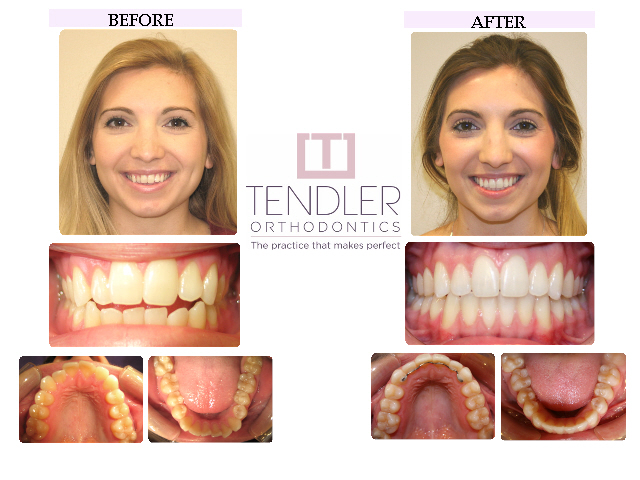 Patient Photo: Invisalign Case 8 Before & After