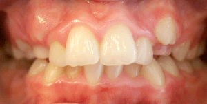 Before patient photo: Crowding and spacing of upper and lower teeth