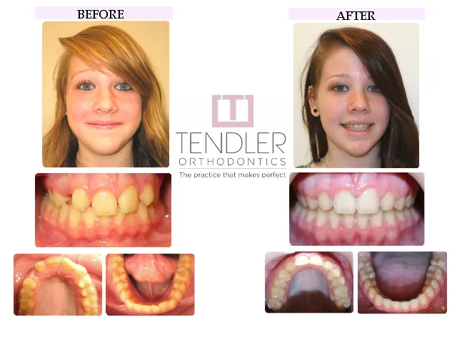 Patient Photo: Dental Braces Case 4 Before & After