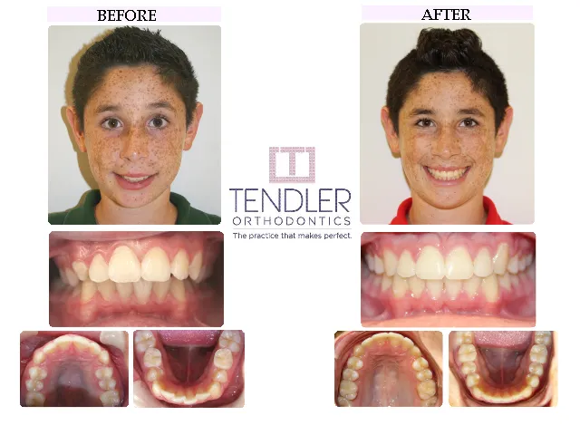 Patient Photo: Dental Braces Case 2 Before & After