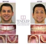 Patient Photo: Dental Braces Case 10 Before & After
