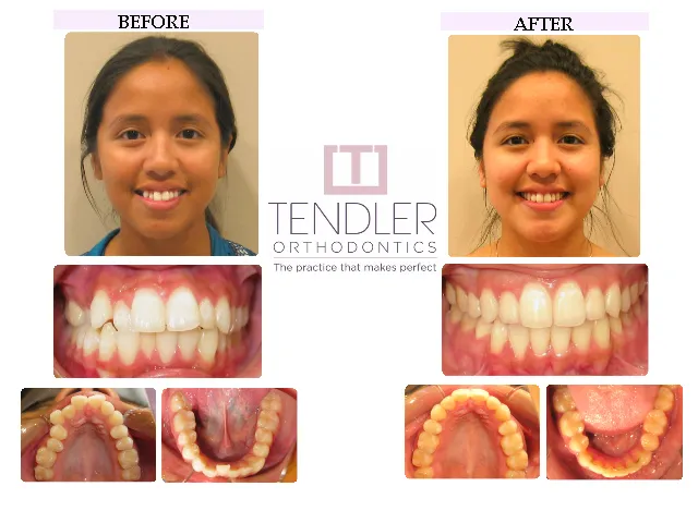 Patient Photo: Dental Braces Case 8 Before & After