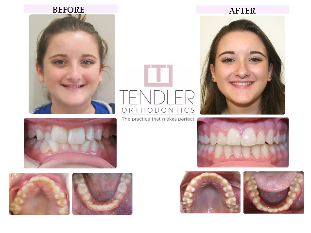 Patient Photo: Dental Braces Case 1 Before & After