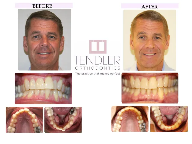 Patient Photo: Invisalign Case 3 Before & After