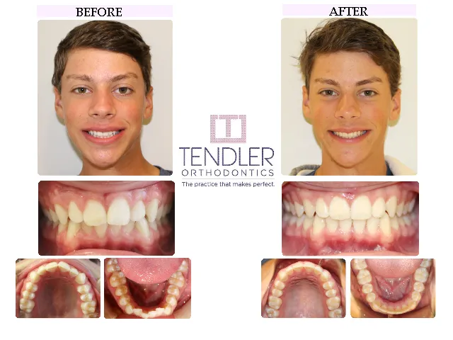 Patient Photo: Invisalign Case 9 Before & After