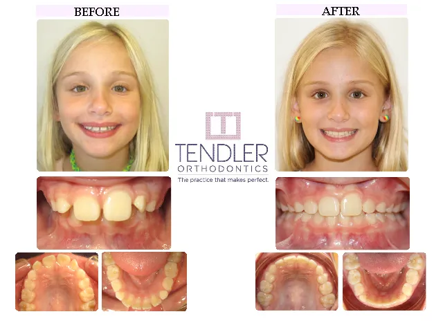 Patient Photo: Interceptive Braces (Phase 1) Case 6 Before & After